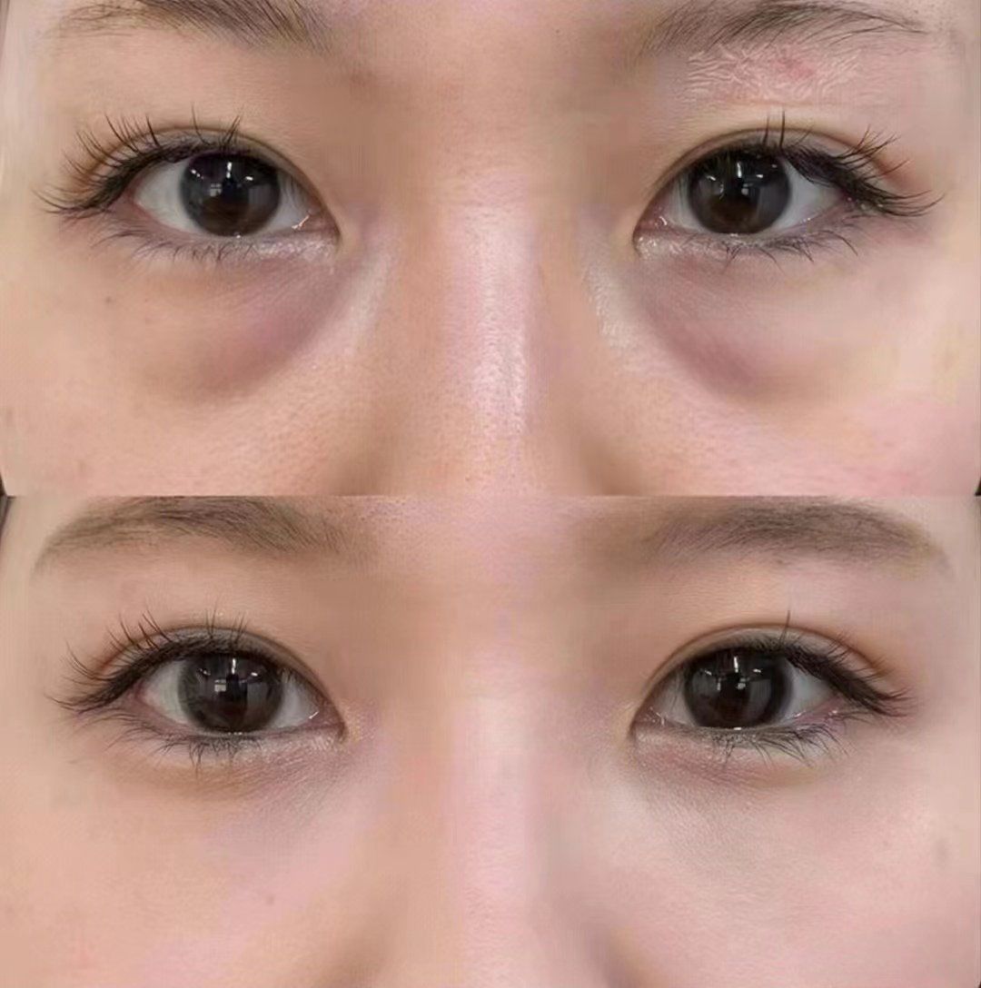 整容去眼袋，真的有效吗？