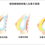 假体隆胸多少钱？假体隆胸手术价格