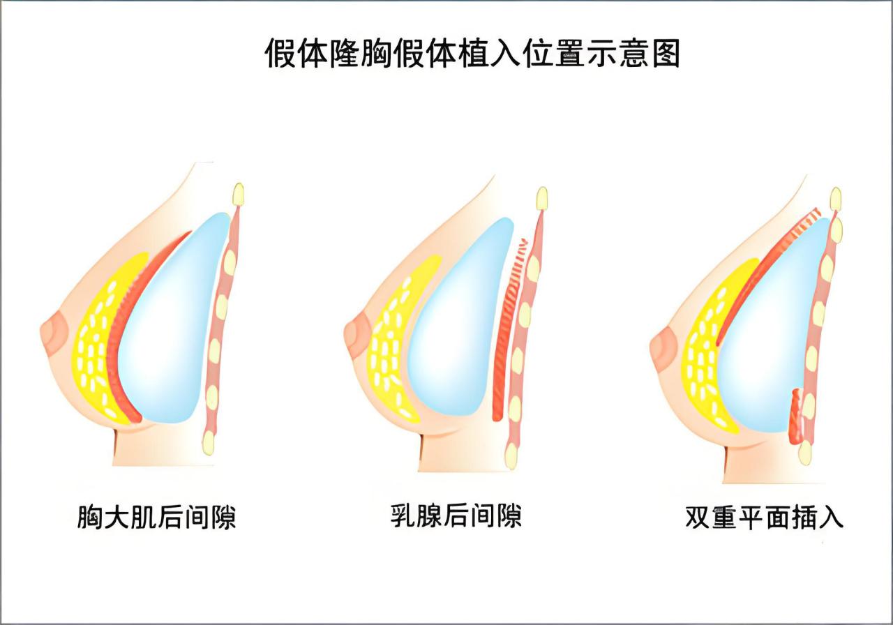 假体隆胸多少钱？假体隆胸手术价格插图