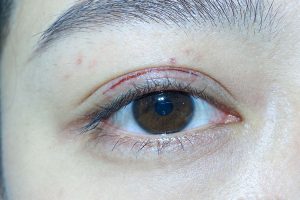 切开双眼皮