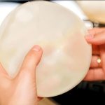 娜高假体隆胸多少钱？娜高假体隆胸价格及效果分析