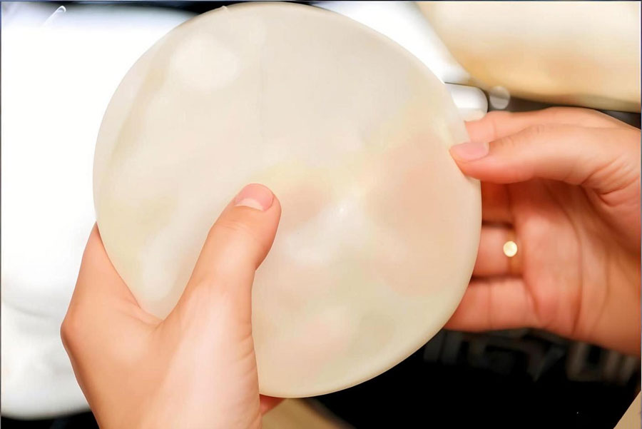 娜高假体隆胸多少钱？娜高假体隆胸价格及效果分析