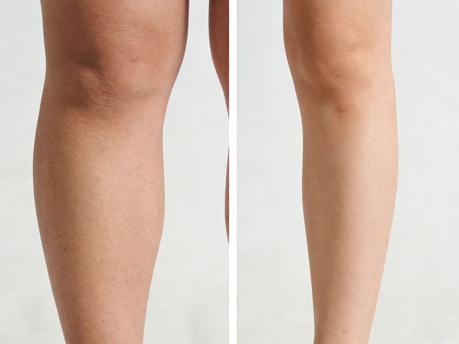 小腿吸脂手术价格多少？全面了解费用详情插图1