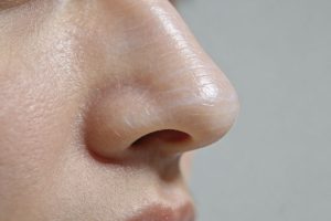 膨体隆鼻