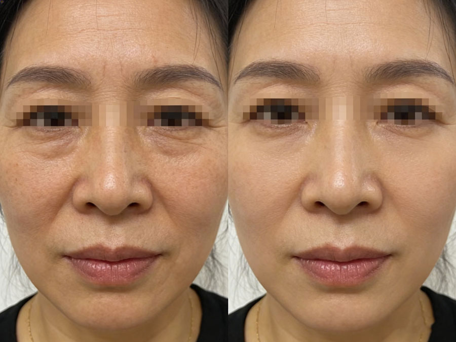 自体脂肪除皱自然抗皱的新选择（自体脂肪除皱的原理、效果与注意事项）插图2