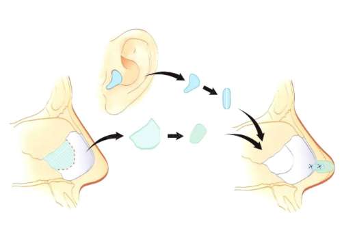 八大处于晓波做耳再造怎么样？三维雕塑+自然逼真、满意度高！插图4