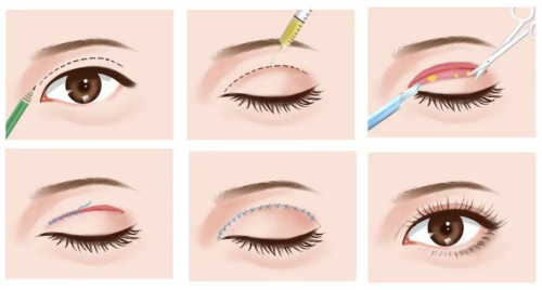 九院董佳威双眼皮修复怎么样？副主任亲操，疤痕粘连松解一绝，口碑爆棚插图2