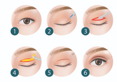 大连牟广隆和李研双眼皮谁做的好？常用术式、线条设计、恢复期表现大盘点插图