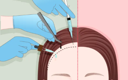 上海植发陈云锦 · 医生简介、擅长项目、收费价格一览插图1