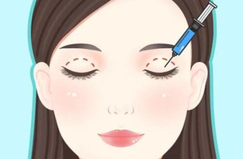 赵兴阳双眼皮案例解析：切口设计、弧度走向、疤痕情况插图