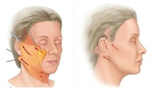 卢丙仑教授做拉皮手术价格是多少？技术实力与收费标准，附真实案例插图2