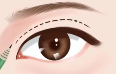 唐毅医生双眼皮技术好吗？切开、埋线、微创各类案例逐一解析插图