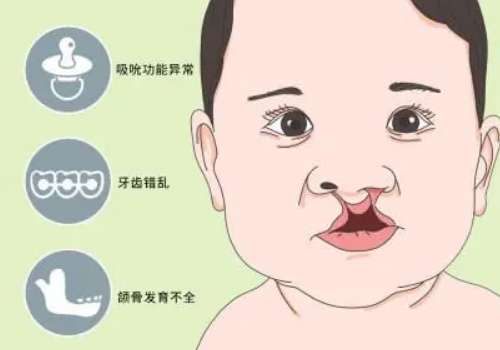 北京八大处王永前唇裂案例一览！2026真实反馈：技术稳、缝合精细！插图