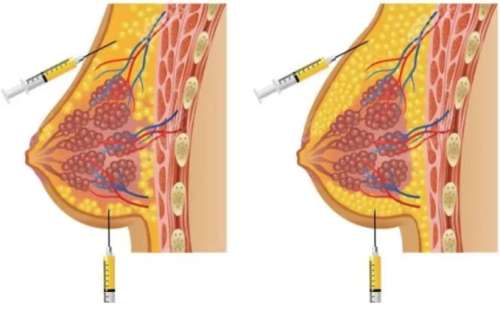 樊辉华医生口碑怎么样？胸部整形医生推荐 | 壹加壹医院插图3