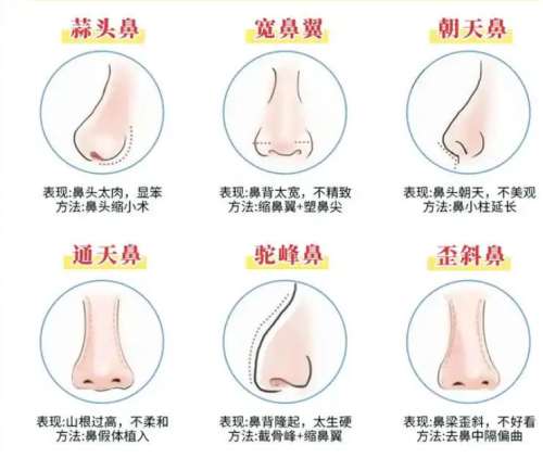 广州颜玲做鼻子如何？在哪里坐诊？医生简介|网友案例亲测插图2