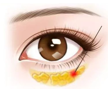 苏州沈国良去眼袋怎么样?技术优势、案例效果与价格区间插图