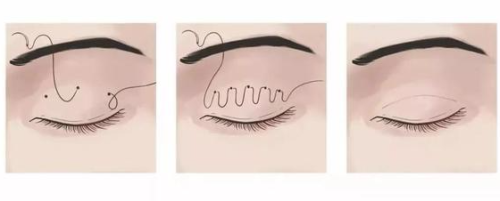 九院董佳威双眼皮修复怎么样？副主任亲操，疤痕粘连松解一绝，口碑爆棚插图1