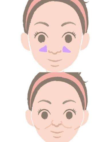 北京路会医生做鼻基底填充多少钱？玻尿酸3千元起\再生材料1.2万元起…插图1