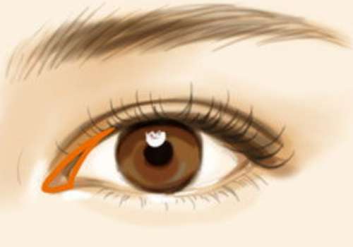 哈医大一院吕冰洁双眼皮修复怎么样？技术优势与案例分享，附价格表插图1