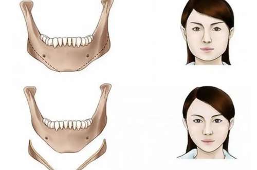 九院柴岗技术怎么样？做下颌角怎么样？经典案例展示插图3