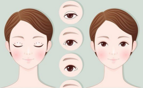 王淑杰做双眼皮怎么样？是否肿胀久、疤痕明显、效果自然度全盘点插图