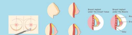 汪帅医生口碑怎么样？胸部整形医生推荐 | 济南华韩插图3