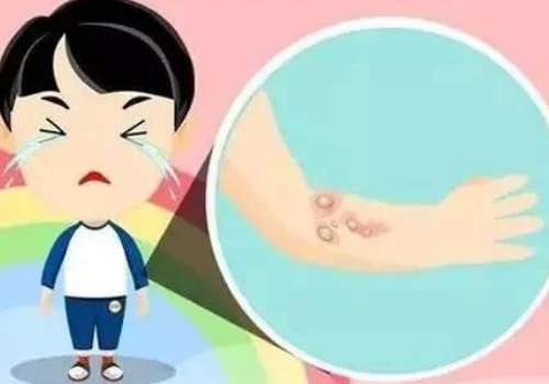 上海九院黄如林做疤痕怎么样？注射、激光、手术修复手段好插图