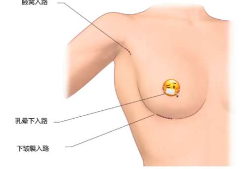 刘永波医生口碑怎么样？胸部整形医生推荐 | 佛山曙光金子医学插图2