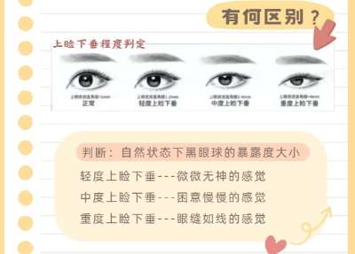 广州南方医院胡志奇修复双眼皮厉害吗？医生资质、优势分析！插图3