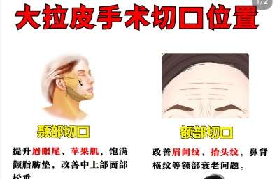 北京陈凤超拉皮手术技术怎么样？医生资质点评！含价格插图4