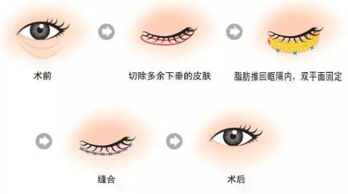 成都黄元利医生口碑怎么样？双眼皮术后自然，价格实惠插图