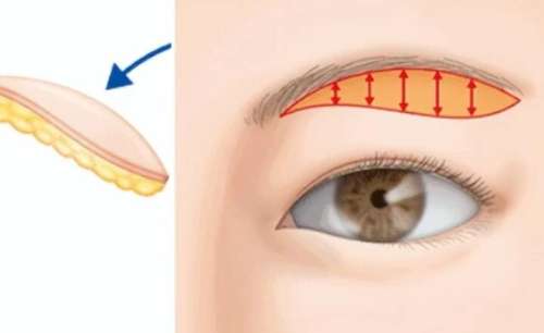 新疆威兹曼整形外科医院刘丽娜提眉怎样？医生简介|网友真实评价！插图3