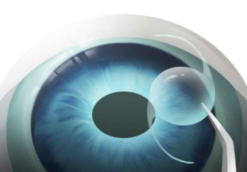 烟台做icl哪个医生好？邵彦明、陈启宁、程华等宝藏医生口碑实测插图3