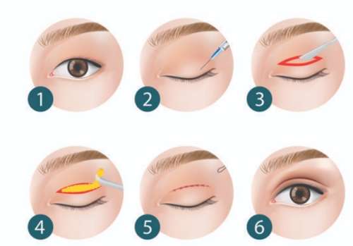 彭太平医生怎么样-胸部整形-韩美插图3