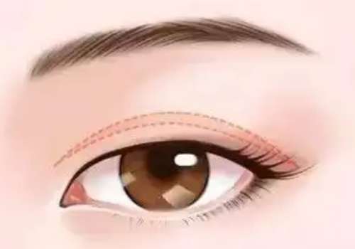 浙二医院方荃医生做眼睛好吗？主打自然妈生感、技术成熟！插图4