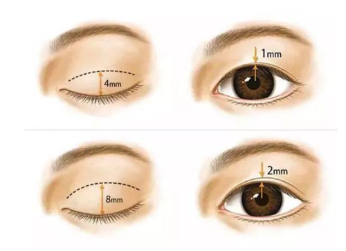 成都王立鹏做双眼皮修复怎么样？技术稳定，修复案例丰富插图1