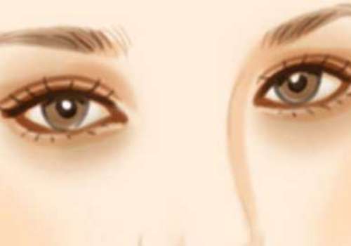 哈医大祝仰东做双眼皮怎么样？哈尔滨医美圈反馈：技术稳，闭眼痕迹淡插图1