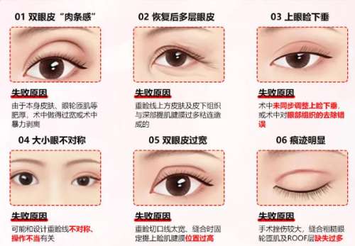 九院刘莺擅长什么？做双眼皮怎么样？案例图展示插图4