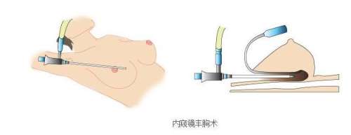 张冠勋医生怎么样-胸部整形-济南诺德美容插图3
