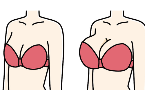 孙家明医生隆胸技术分析：切口选择、植入层次、术后形态一文读懂插图