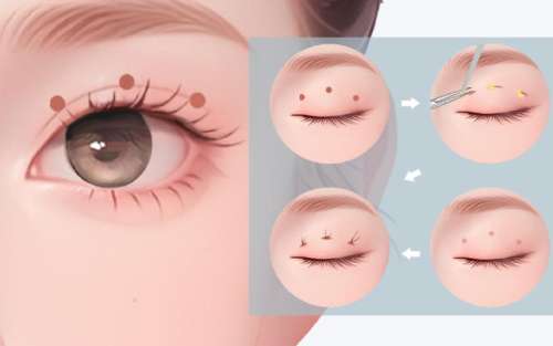 陈建平医生怎么样-双眼皮整形-成都成华俏百颜莱优医疗美容门诊部插图2