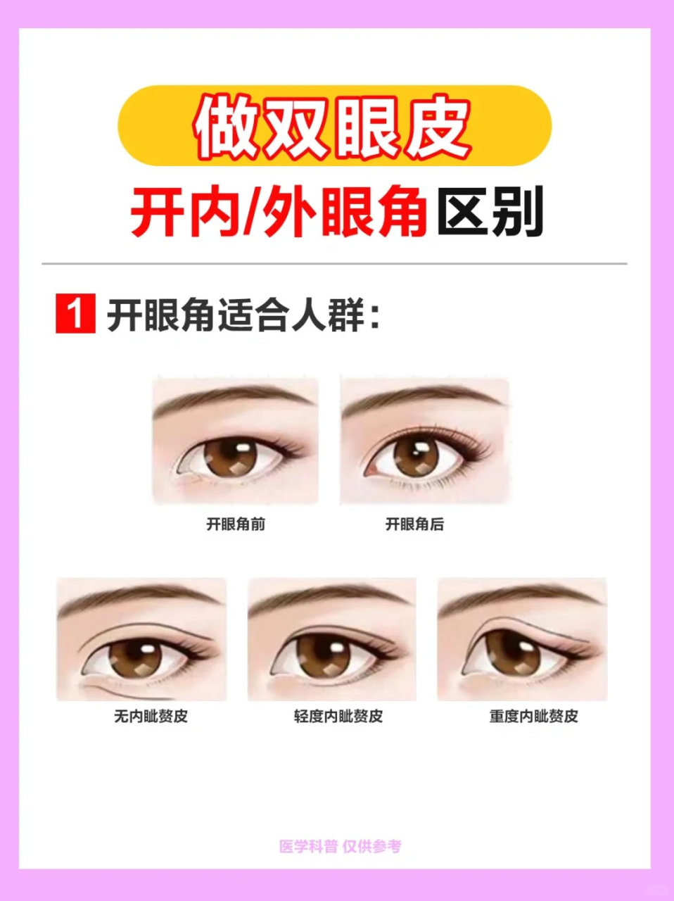 开眼角手术的注意事项