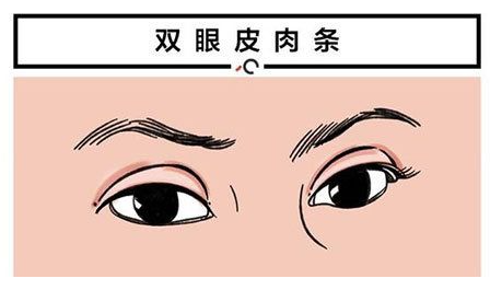 彭千飞双眼皮技术怎样？审美在线，术后效果自然插图3