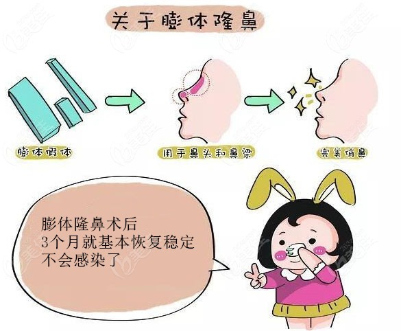 关于隆鼻术手术，你需要知道的一些知识点插图2