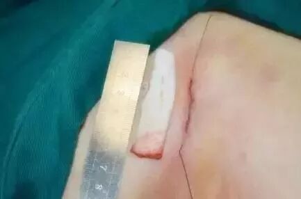 这么多种隆鼻材料，要怎么选？插图5