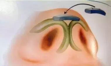 这么多种隆鼻材料，要怎么选？插图6