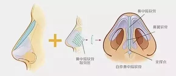 这么多种隆鼻材料，要怎么选？插图7