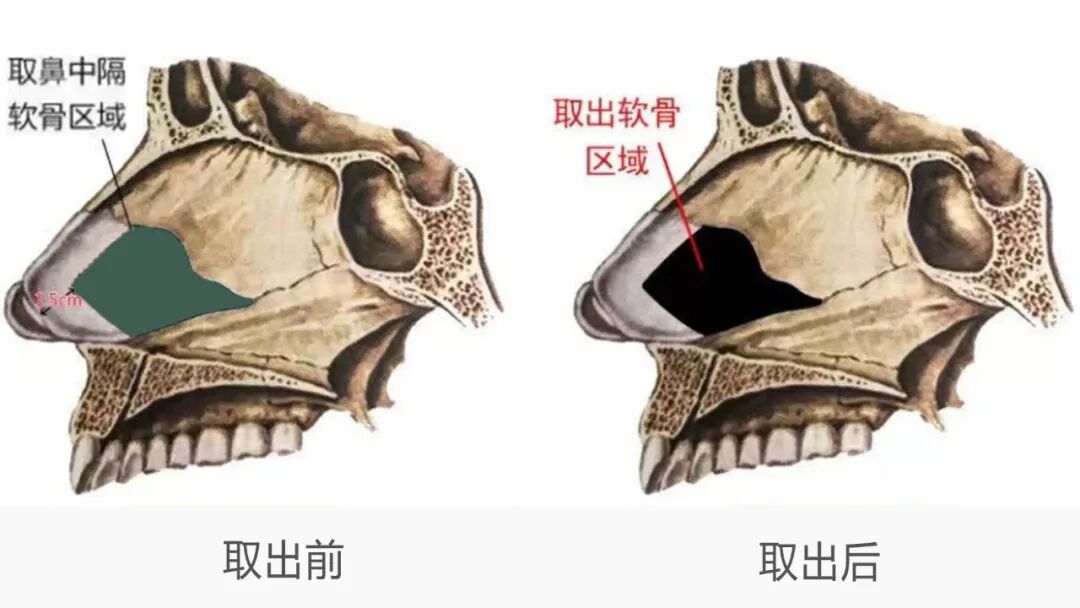 隆鼻技术 | 鼻尖整形中建议取鼻中隔软骨吗？插图1