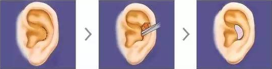 耳软骨、肋软骨、鼻中隔，用它们隆鼻有啥区别？插图