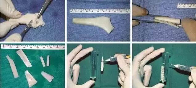 这么多种隆鼻材料，要怎么选？插图8